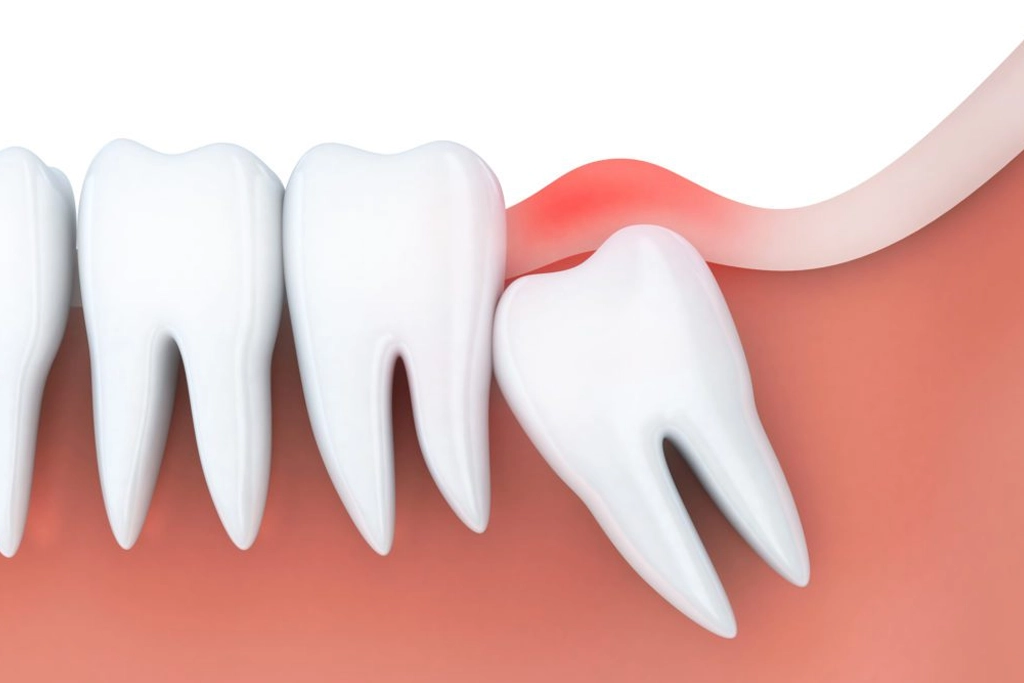 Dental implants in saibaba colony