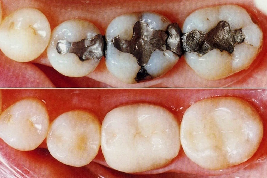 Dental implants in sivananda colony